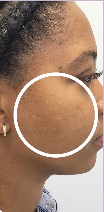 Skin Tone & Texture Before & After Patient #17764