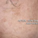 Skin Tone & Texture Before & After Patient #17576