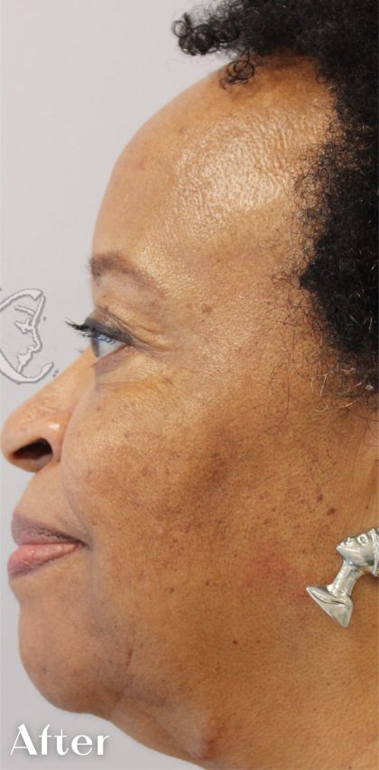 Skin Tone & Texture Before & After Patient #17591