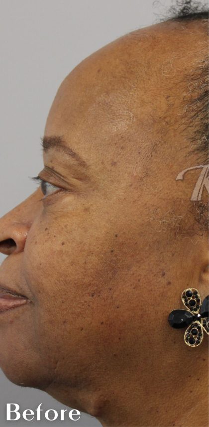 Skin Tone & Texture Before & After Patient #17591