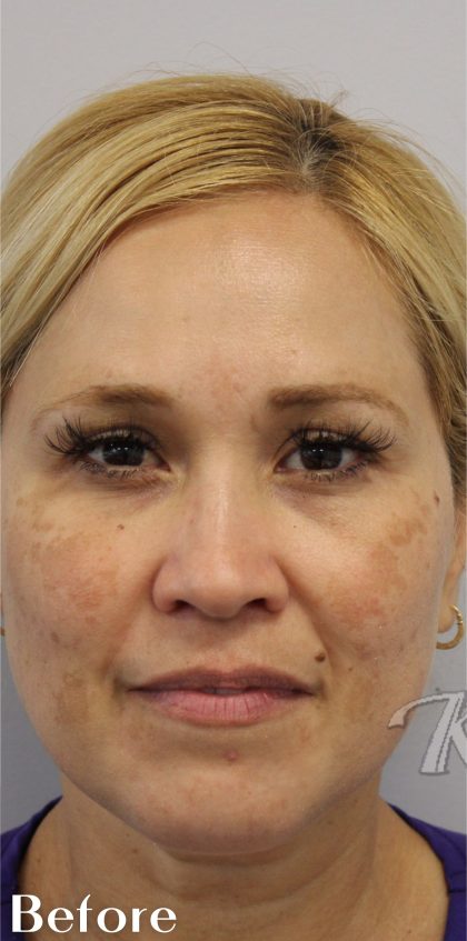Skin Tone & Texture Before & After Patient #17600