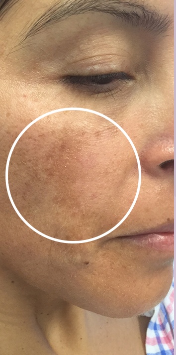 Skin Tone & Texture Before & After Patient #17793