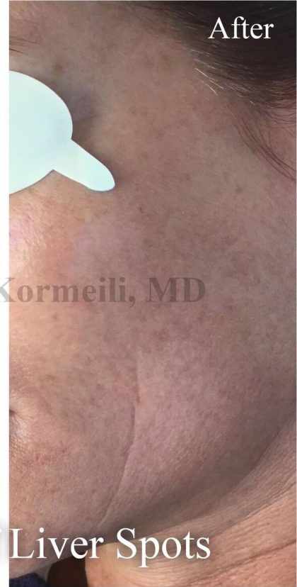 Skin Tone & Texture Before & After Patient #17705