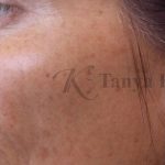 Skin Tone & Texture Before & After Patient #17705