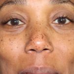 Skin Tone & Texture Before & After Patient #17707
