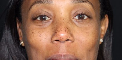 Skin Tone & Texture Before & After Patient #17707