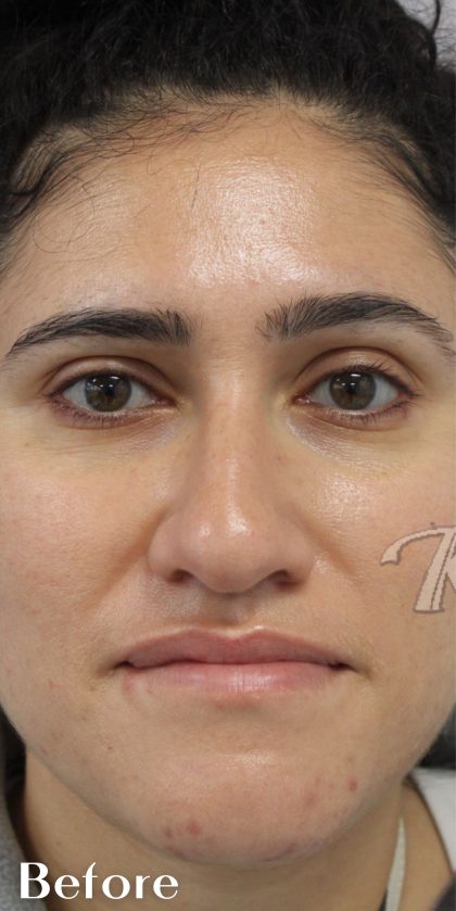 Skin Tone & Texture Before & After Patient #17624