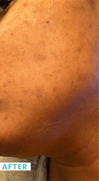 Skin Tone & Texture Before & After Patient #17715