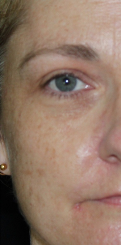 Skin Tone & Texture Before & After Patient #17795