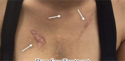 Scar Removal Before & After Patient #11097