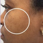 Skin Tone & Texture Before & After Patient #17764