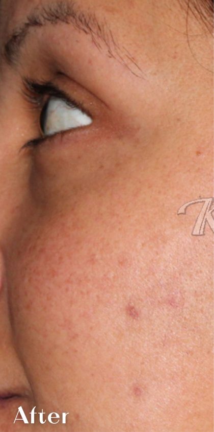 Skin Tone & Texture Before & After Patient #17718