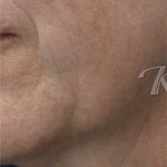 Skin Tone & Texture Before & After Patient #17722