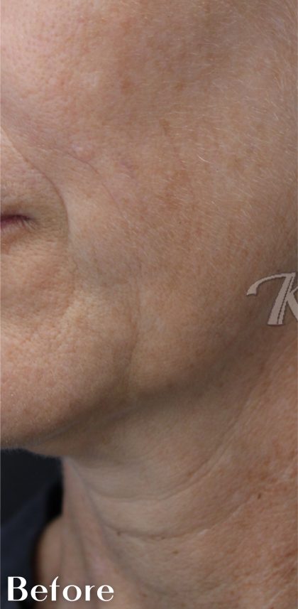 Skin Tone & Texture Before & After Patient #17722