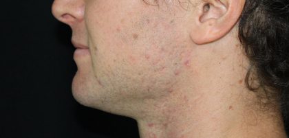 Necks & Jawline Before & After Patient #17905