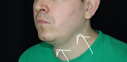 Necks & Jawline Before & After Patient #17906