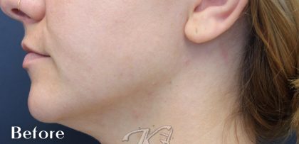 Necks & Jawline Before & After Patient #17908