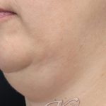 Necks & Jawline Before & After Patient #17910