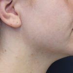 Necks & Jawline Before & After Patient #17914