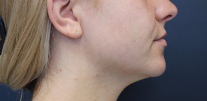 Necks & Jawline Before & After Patient #17914