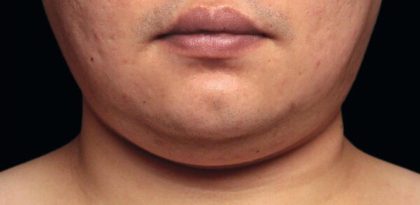 Necks & Jawline Before & After Patient #17922