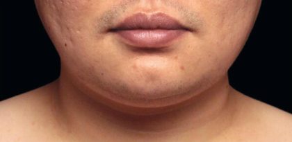 Necks & Jawline Before & After Patient #17922