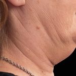 Necks & Jawline Before & After Patient #17924