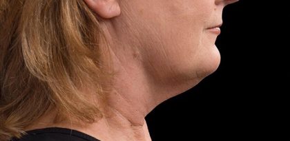 Necks & Jawline Before & After Patient #17924