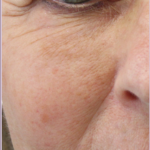 Redness & Rosacea Before & After Patient #18148