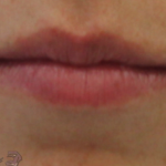 Lip Augmentation Before & After Patient #18194