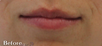 Lip Augmentation Before & After Patient #18194