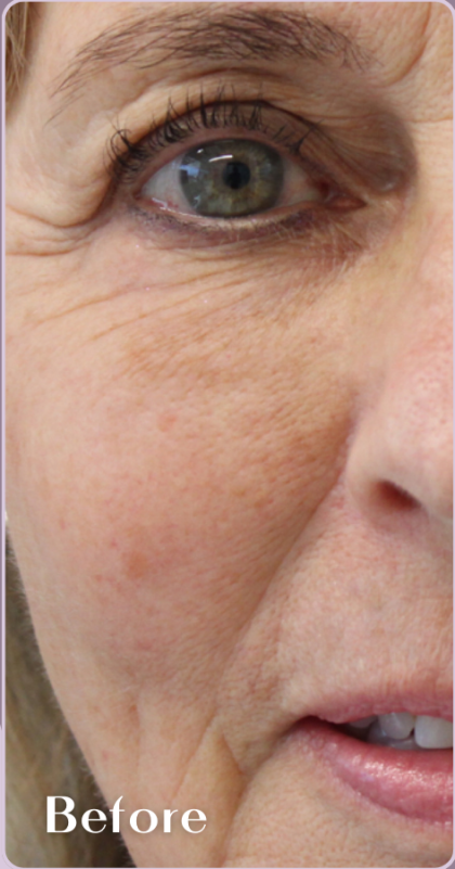 Redness & Rosacea Before & After Patient #18148