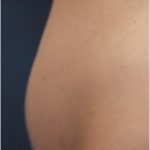 Body Contouring Before & After Patient #18098