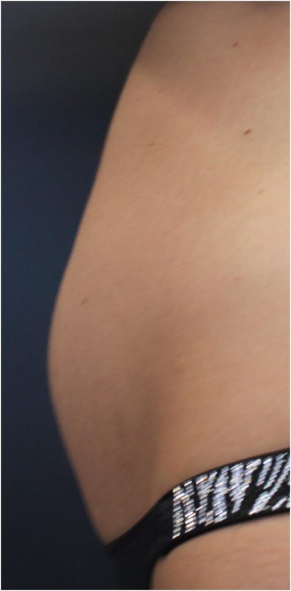 Body Contouring Before & After Patient #18098