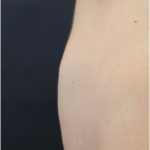 Body Contouring Before & After Patient #18098