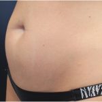 Body Contouring Before & After Patient #18098