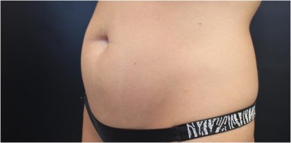 Body Contouring Before & After Patient #18098