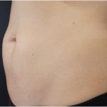 Body Contouring Before & After Patient #18098