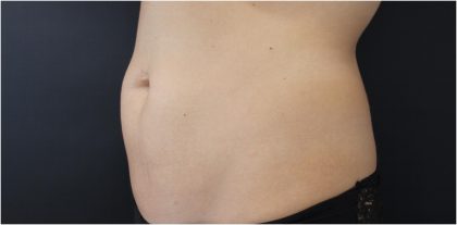 Body Contouring Before & After Patient #18098