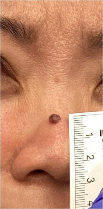 Cosmetic Mole Removal Before & After Patient #18102