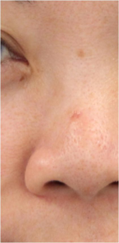 Cosmetic Mole Removal Before & After Patient #18102