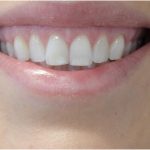 Gummy Smiles Before & After Patient #18106