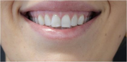 Gummy Smiles Before & After Patient #18106