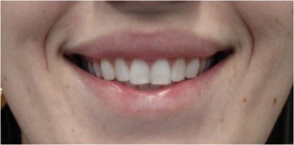 Gummy Smiles Before & After Patient #18106