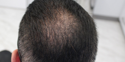 Hair Restoration Before & After Patient #18107