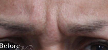 Lines & Wrinkles Before & After Patient #18112