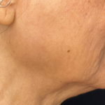 Necks & Jawline Before & After Patient #18145