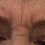 Lines & Wrinkles Before & After Patient #18140