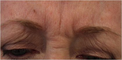 Lines & Wrinkles Before & After Patient #18140