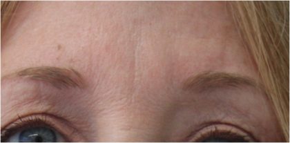 Lines & Wrinkles Before & After Patient #18140